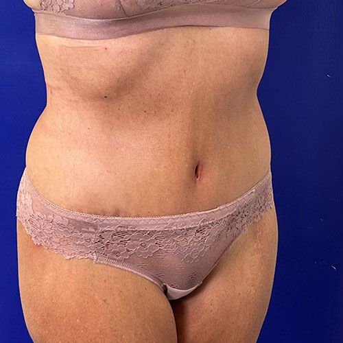 after halo lift right angle view female patient case 5467