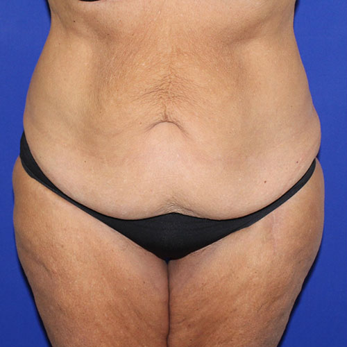 before halo lift front view female patient case 5467