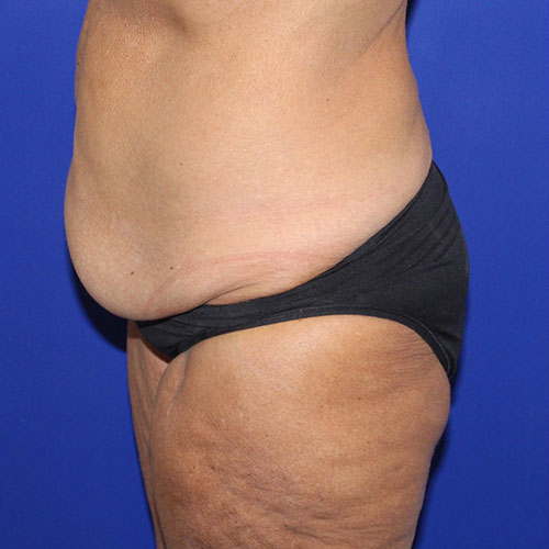 before halo lift left view female patient case 5467