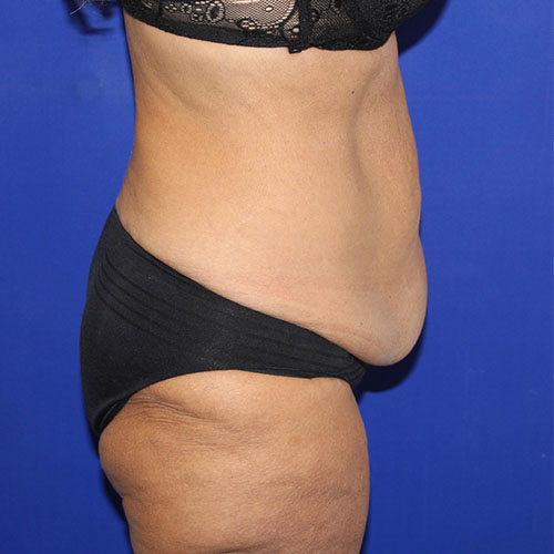 before halo lift right view female patient case 5467