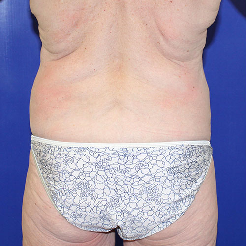 before halo lift back view female patient case 5476