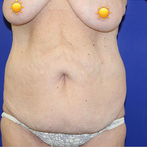 before halo lift front view female patient case 5476