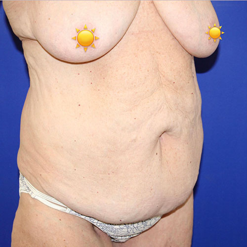 before halo lift right angle view female patient case 5476