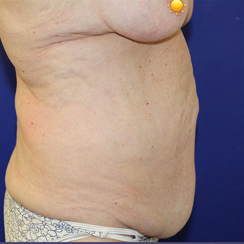 before halo lift right view female patient case 5476