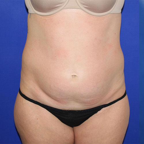 before lipoabdominoplasty front view female patient case 5486