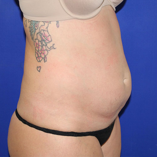 before lipoabdominoplasty right angle view female patient case 5486