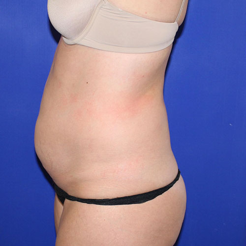 before lipoabdominoplasty left view female patient case 5486