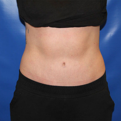 after lipoabdominoplasty front view female patient case 5486