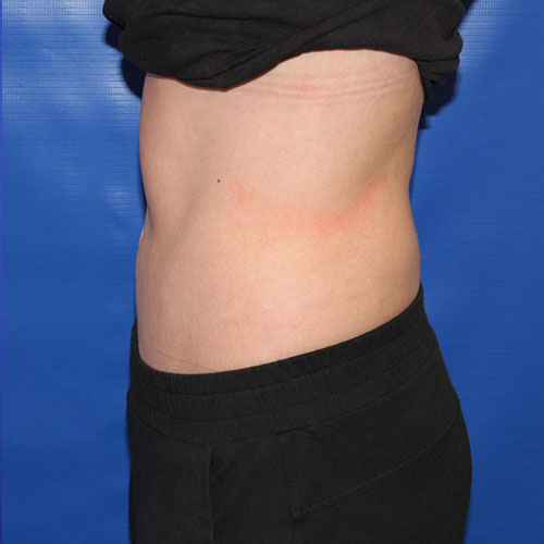 after lipoabdominoplasty left view female patient case 5486