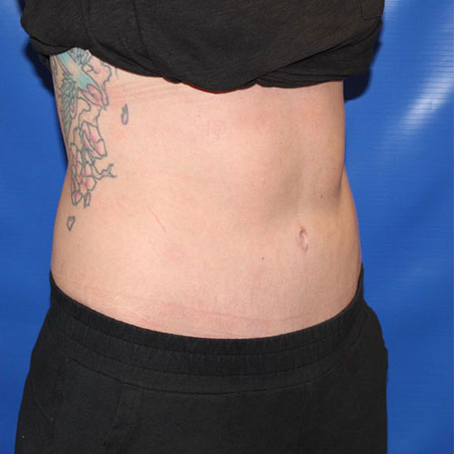 after lipoabdominoplasty right angle view female patient case 5486