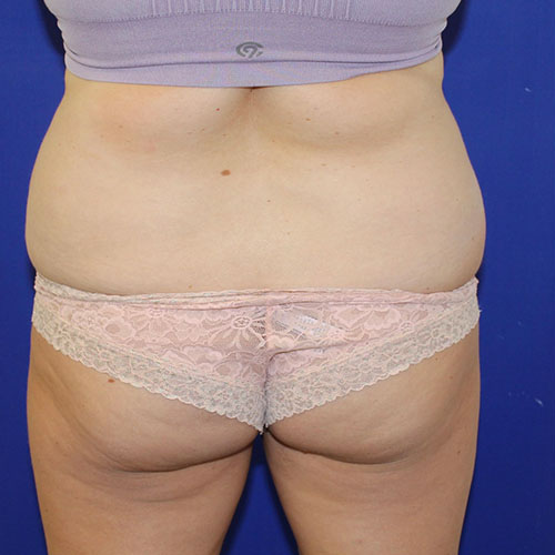 before lipoabdominoplasty back view female patient case 5493