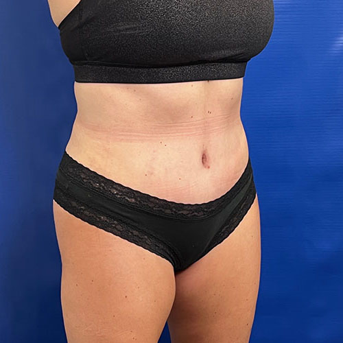 after lipoabdominoplasty right angle view female patient case 5493