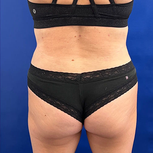 after lipoabdominoplasty back view female patient case 5493