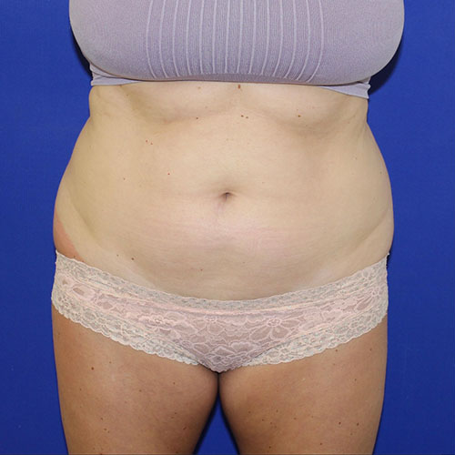 before lipoabdominoplasty front view female patient case 5493