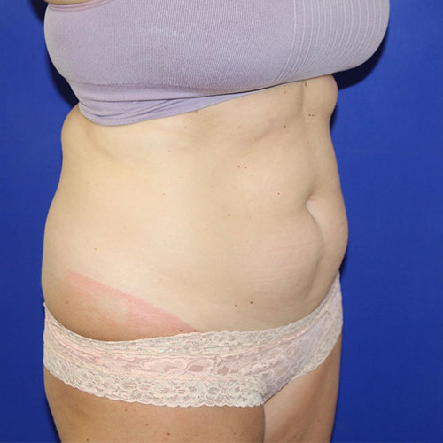 before lipoabdominoplasty right angle view female patient case 5493