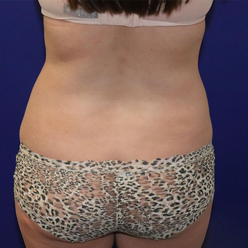Before Lipoabdominoplasty Female Patient Back Angle View Case 5500