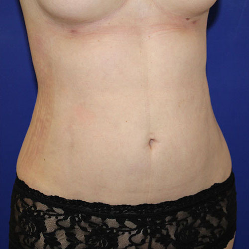 After Lipoabdominoplasty Female Patient Diagonal Angle View Case 5500