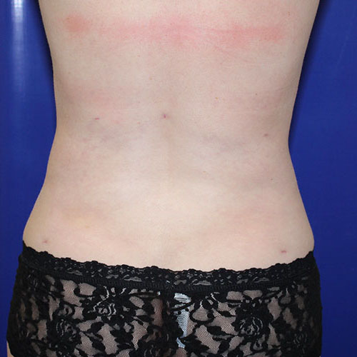 After Lipoabdominoplasty Female Patient Back Angle View Case 5500