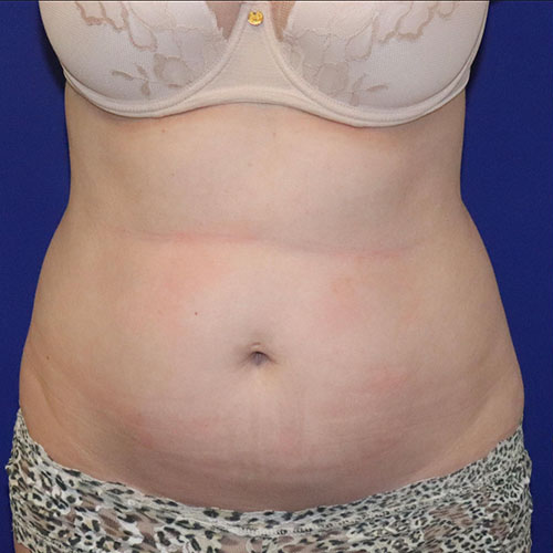 Before Lipoabdominoplasty Female Patient Front Angle View Case 5500