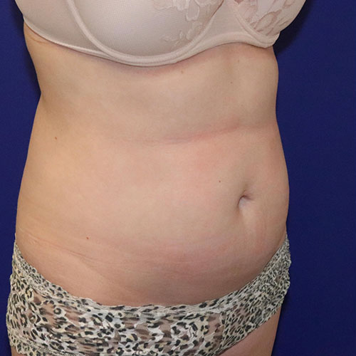 Before Lipoabdominoplasty Female Patient Diagonal Angle View Case 5500