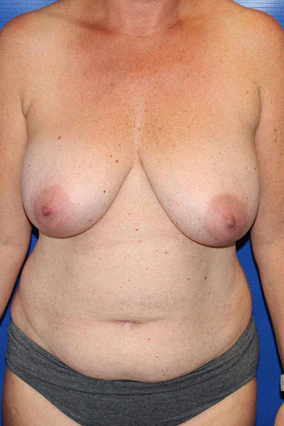 Before Mommy Makeover Female Patient Front Angle View Case 5514